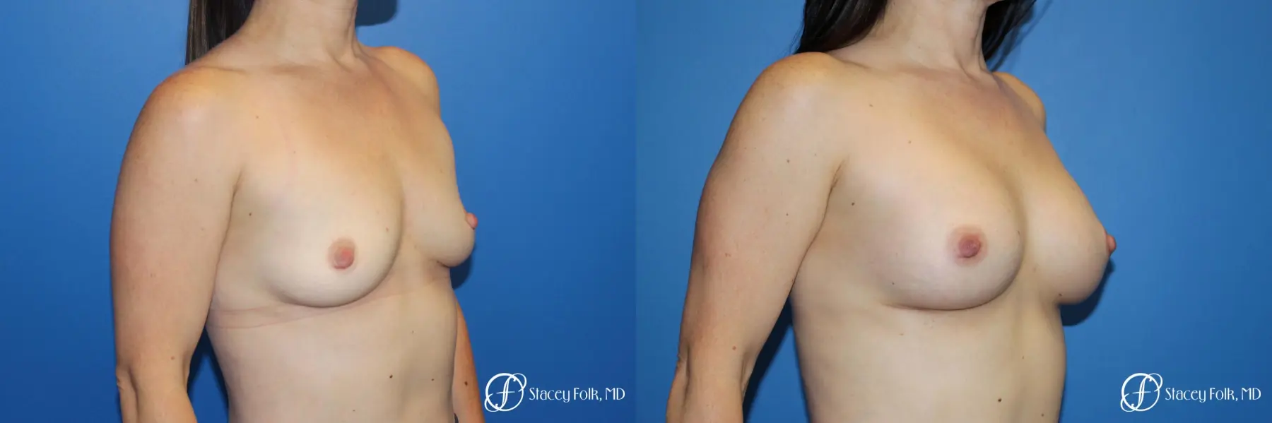 Breast augmentation with Natrelle Inspira breast implants - Before and After 2