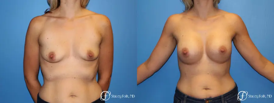 Denver Breast Augmentation 4816 - Before and After 1