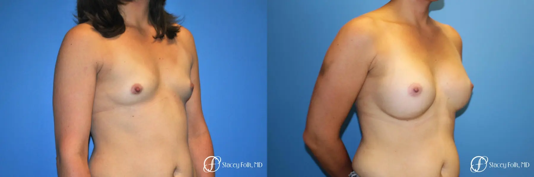 Denver Breast augmentation 7111 - Before and After 2