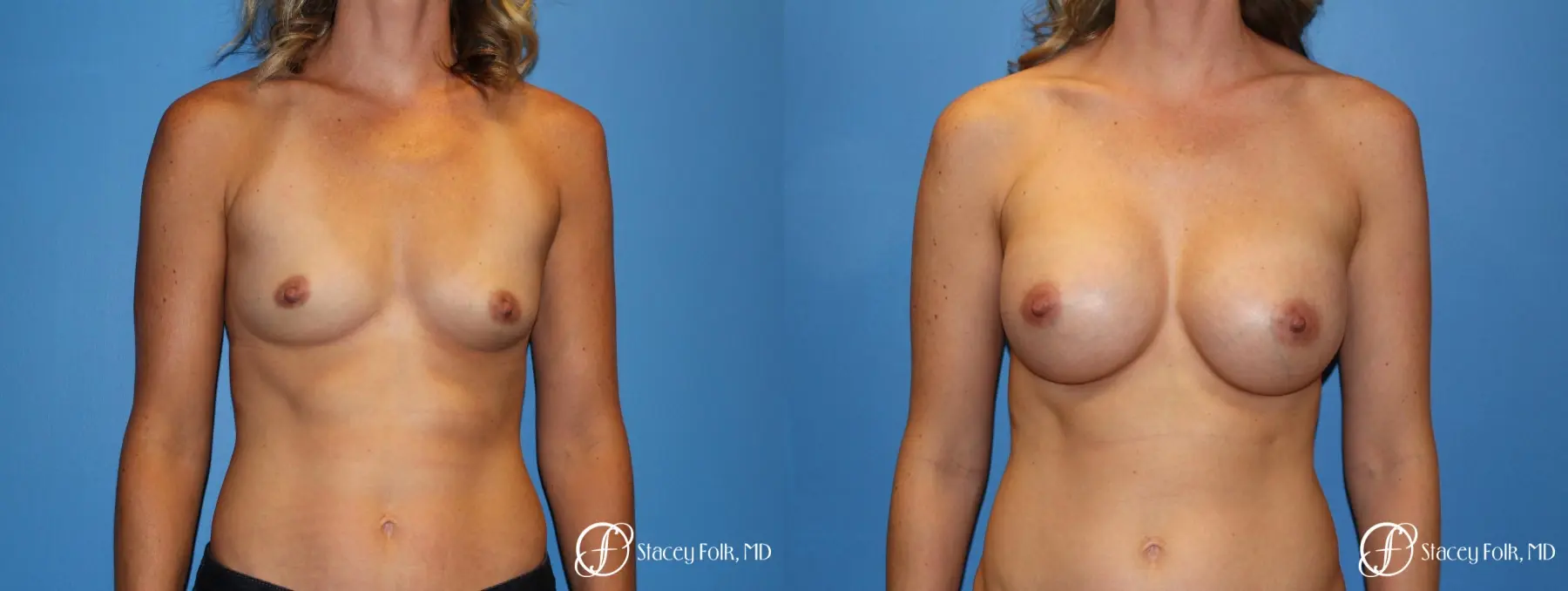 Denver Breast augmentation 4740 - Before and After 1