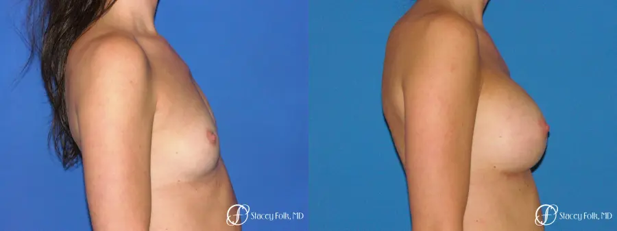 Denver Breast Augmentation 4779 - Before and After 3