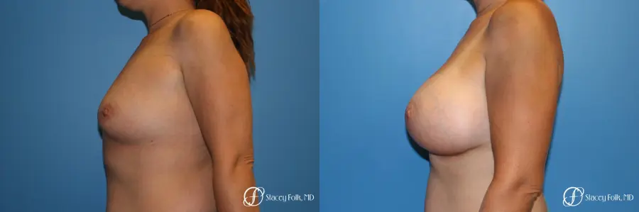 Denver Breast augmentation using textured implants 8271 - Before and After 2