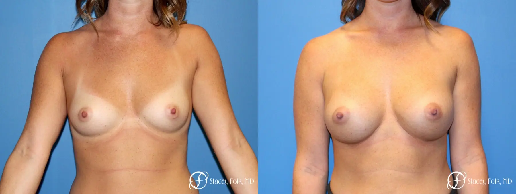 Denver Breast Augmentation using Sientra Silicone Breast Implants 9092 - Before and After 1