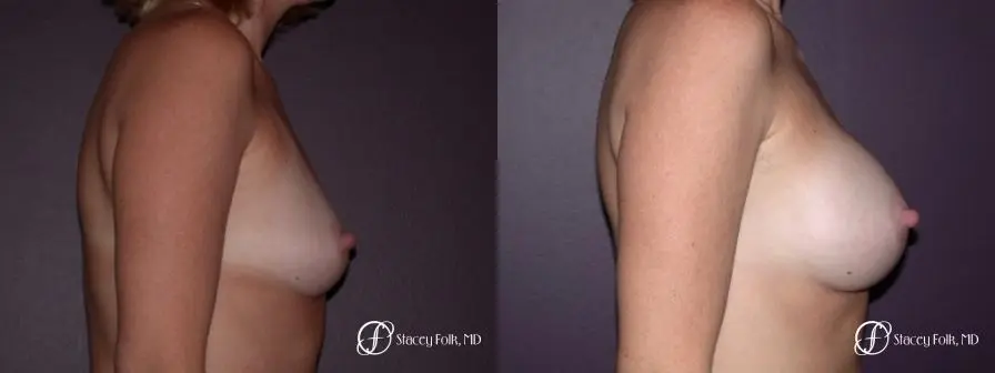 Denver Breast Augmentation 13 - Before and After 3