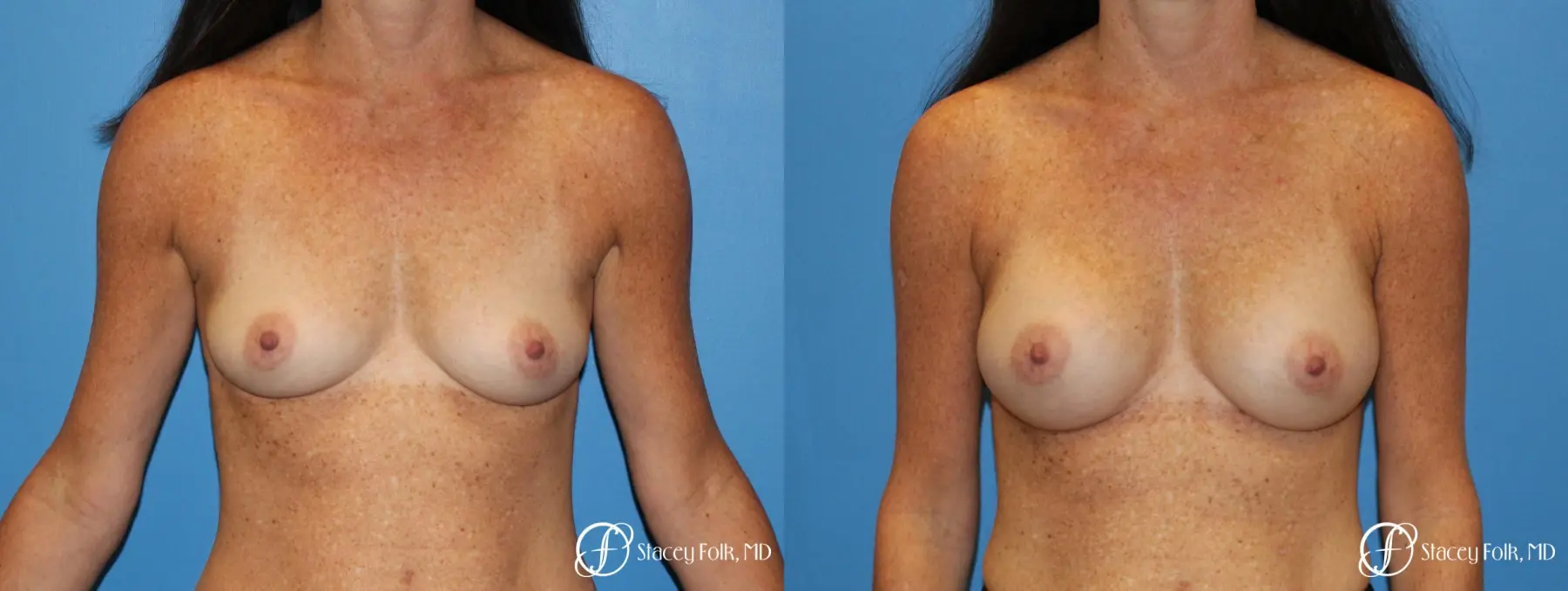 Denver Breast Augmentation using Sientra Silicone Gel Breast Implants 9362 - Before and After
