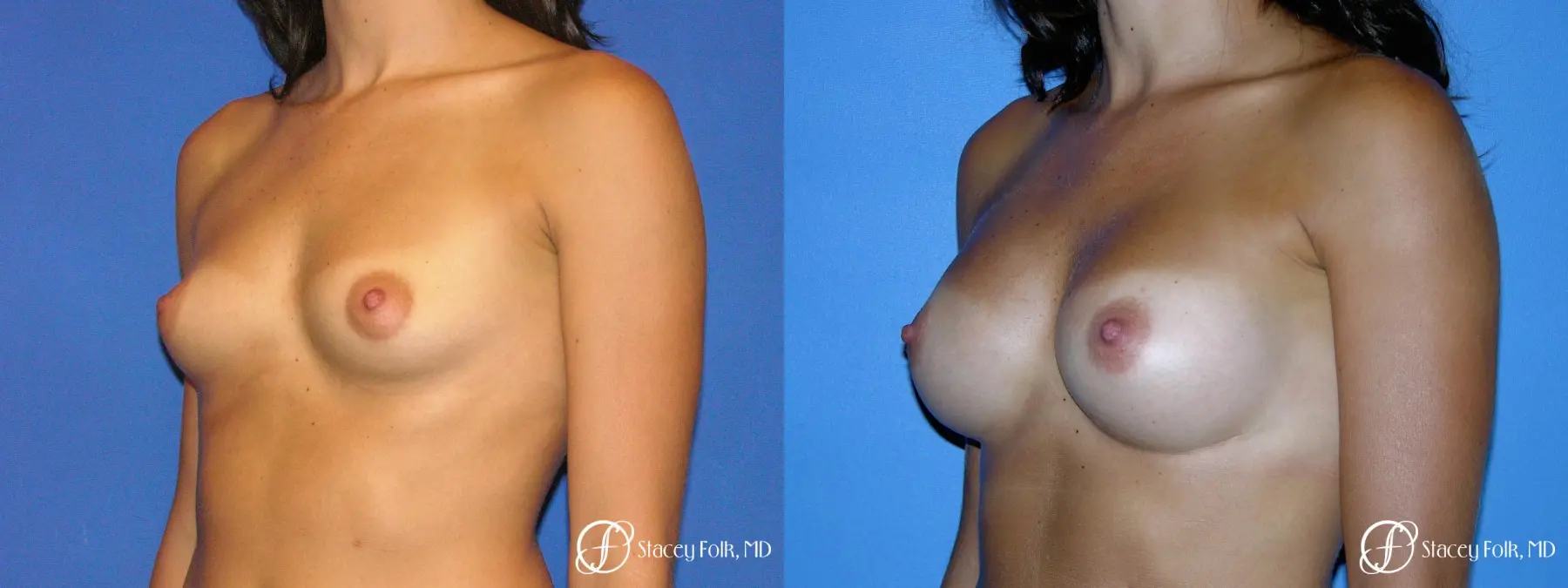 Denver Breast Augmentation 9136 - Before and After 2