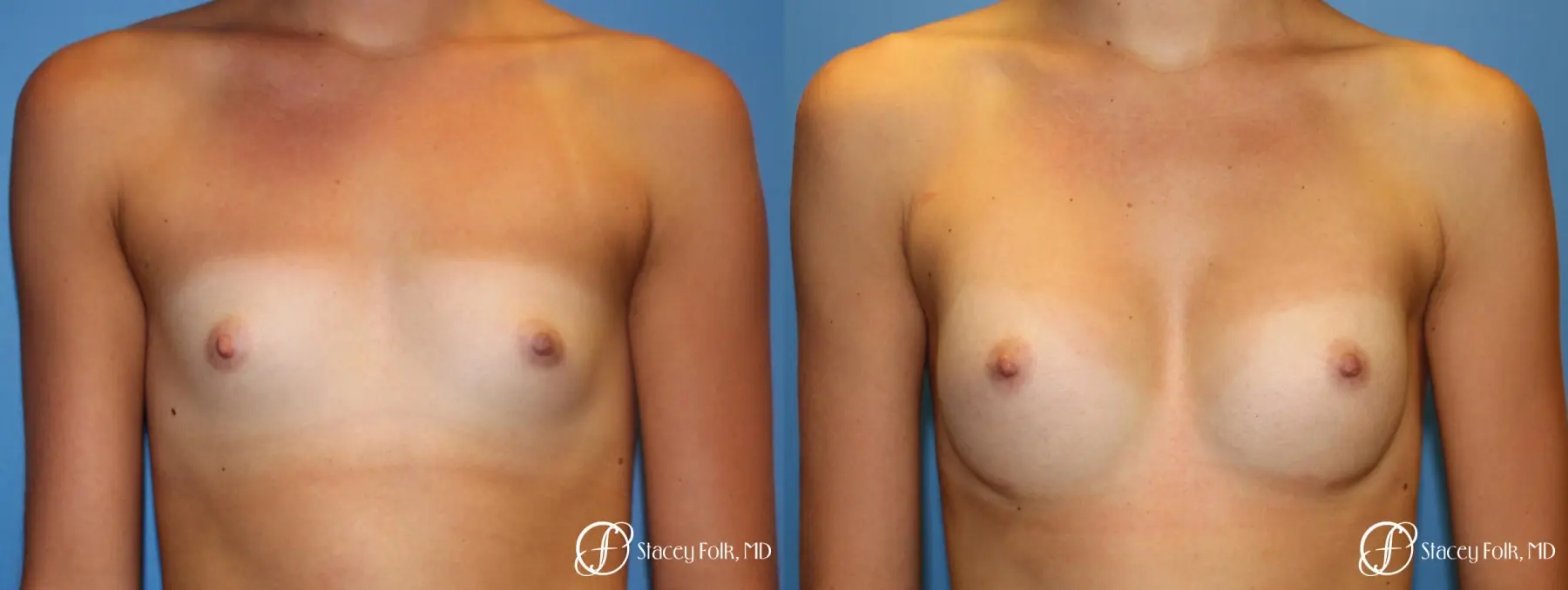 Denver Breast Augmentation with Sientra Breast Implants 9094 - Before and After