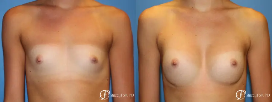 Denver Breast Augmentation with Sientra Breast Implants 9094 - Before and After 1