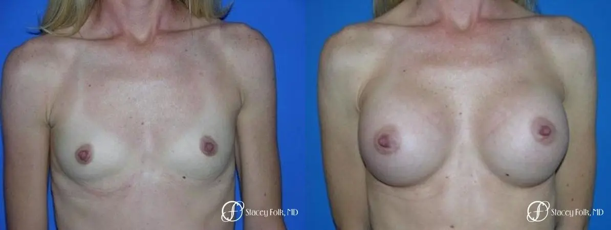 Denver Breast Augmentation 8 - Before and After 1