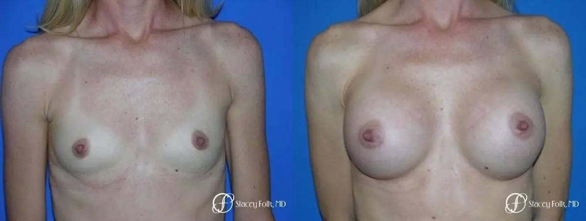 Denver Breast Augmentation 8 - Before and After