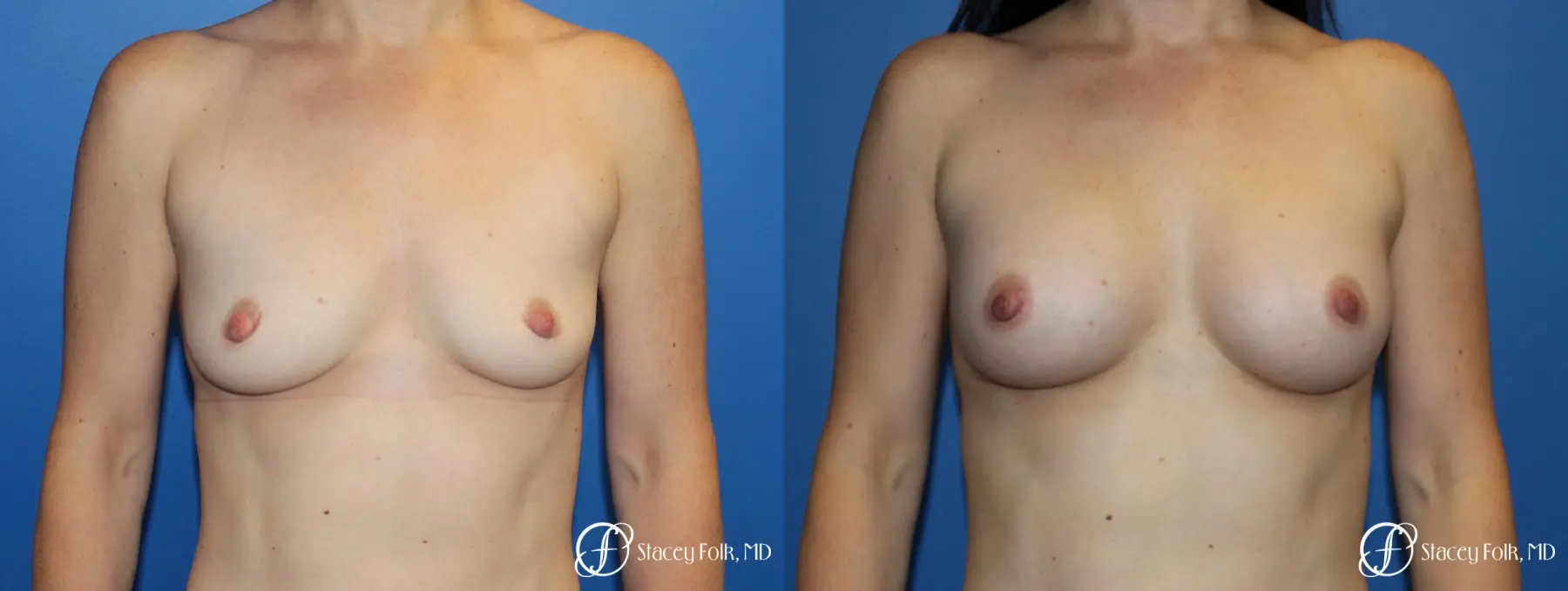 Breast augmentation with Natrelle Inspira breast implants - Before and After 1