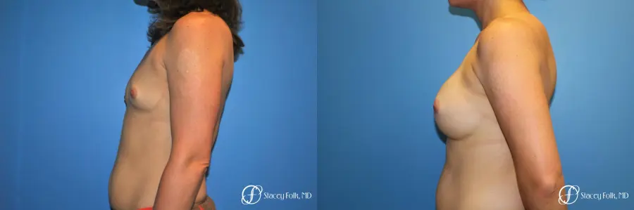 Denver Breast augmentation 7111 - Before and After 3