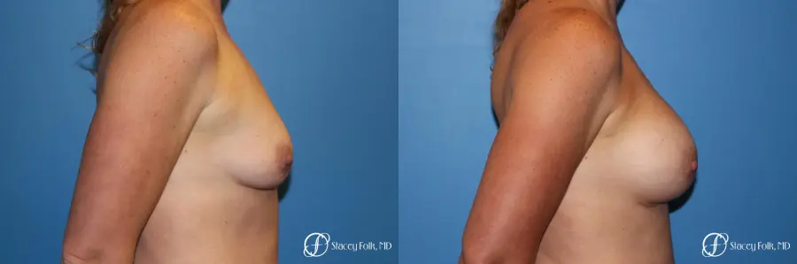 Denver Breast augmentation using Sientra textured anatomic implants 5578 - Before and After 3