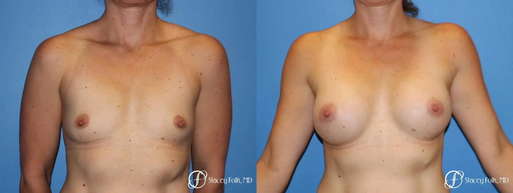 Denver Breast Augmentation 6611 - Before and After 1