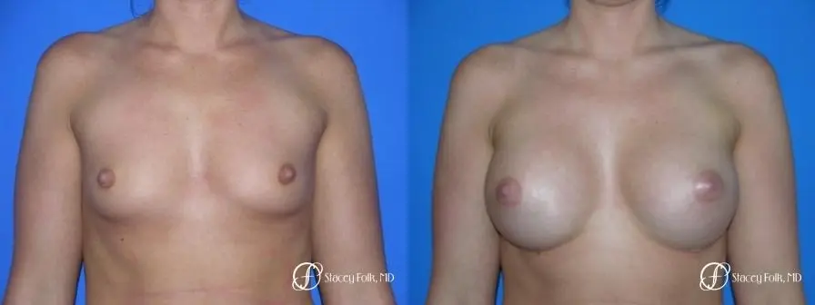 Denver Breast Augmentation 958 - Before and After