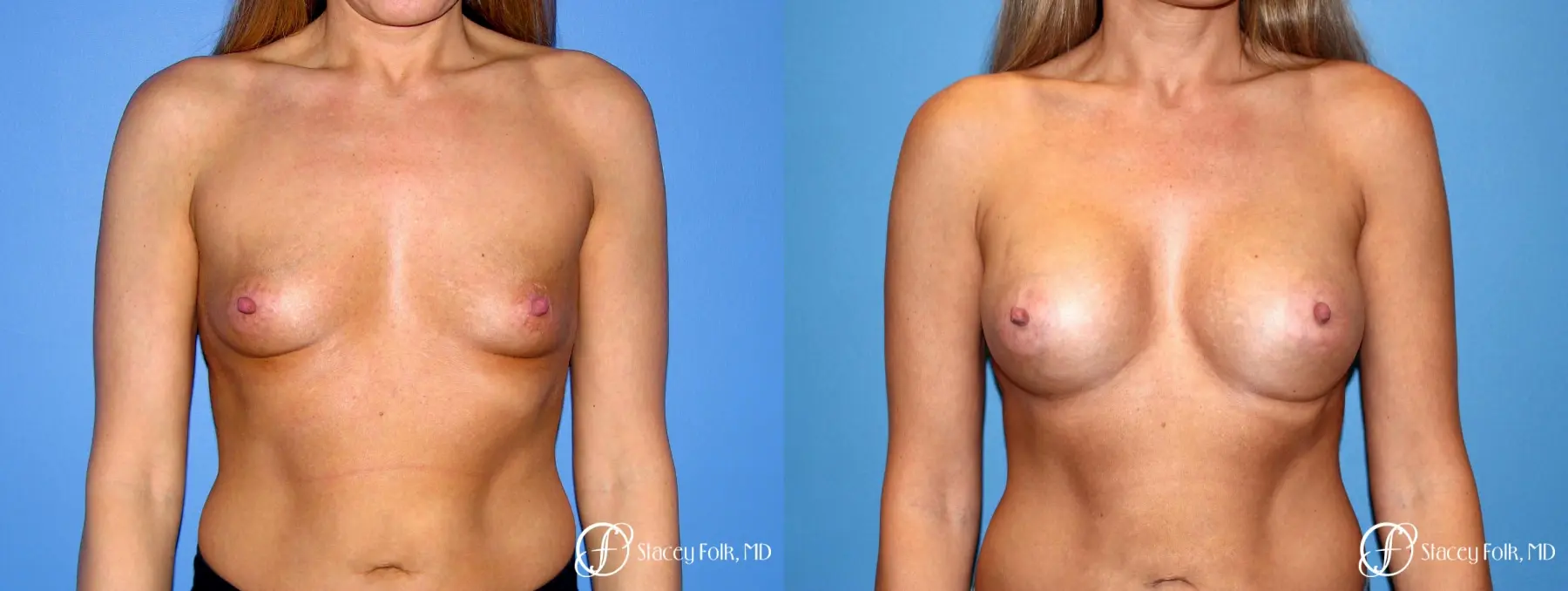 Denver Breast Augmentation 3626 - Before and After 1
