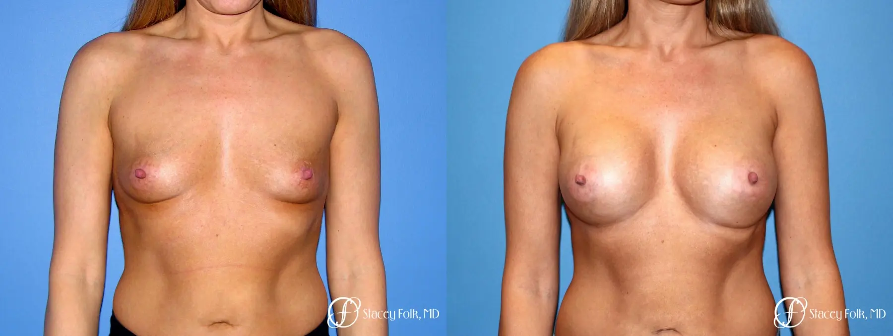 Denver Breast Augmentation 3626 - Before and After