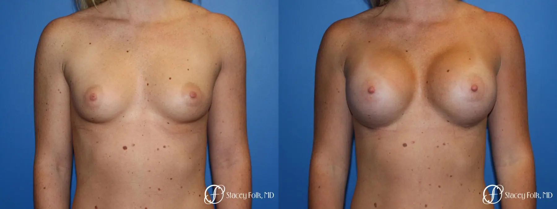 Breast Augmentation with Sientra Textured Implants - Before and After