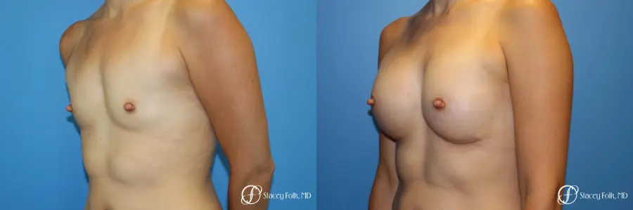 Denver Breast augmentation using textured anatomical implants 5849 - Before and After 2