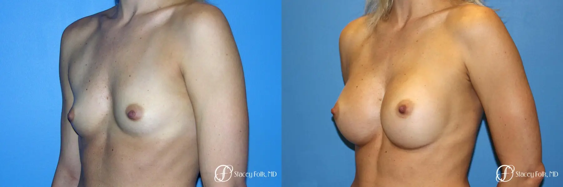 Denver Breast Augmentation 8202 - Before and After 2