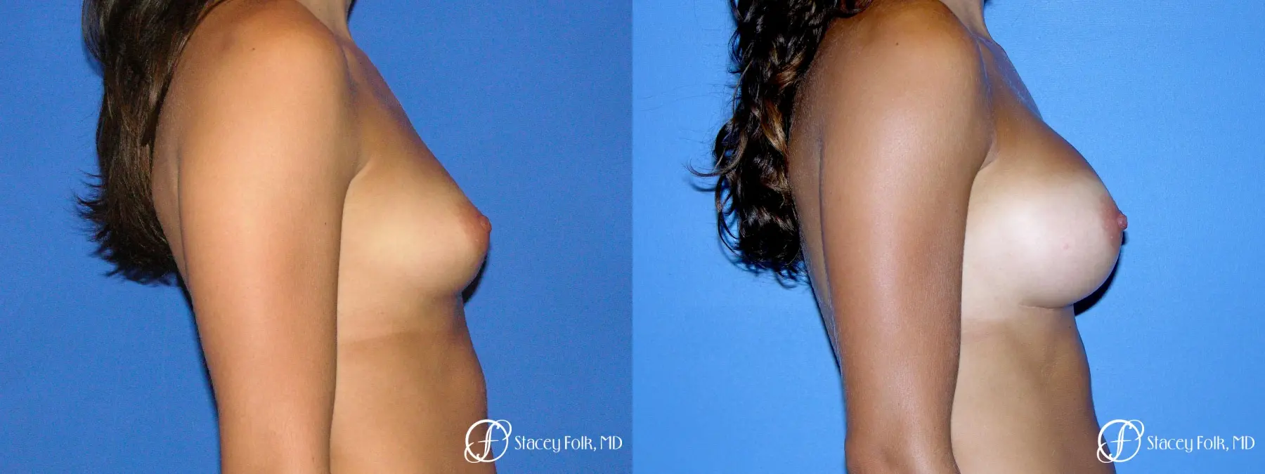 Denver Breast Augmentation 9136 - Before and After 3