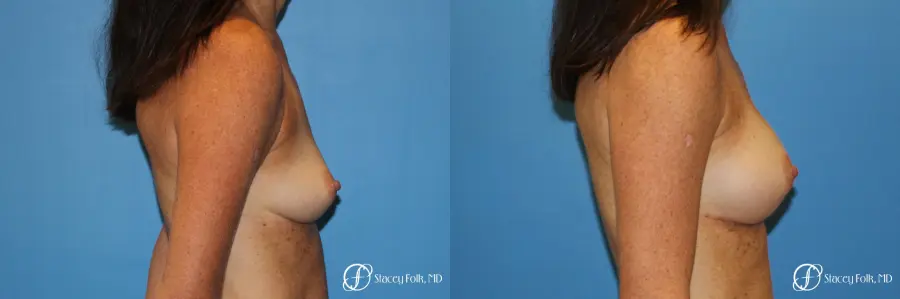Denver Breast Augmentation using Sientra Silicone Gel Breast Implants 9362 - Before and After 3
