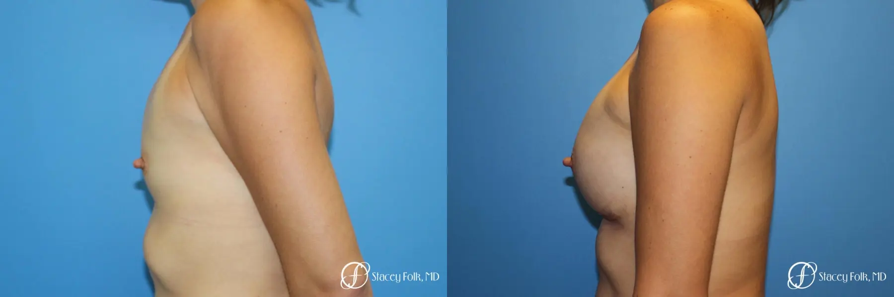 Denver Breast augmentation using textured anatomical implants 5849 - Before and After 3