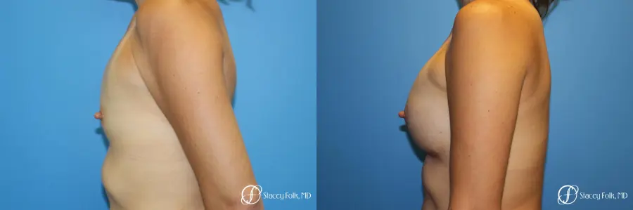 Denver Breast augmentation using textured anatomical implants 5849 - Before and After 3