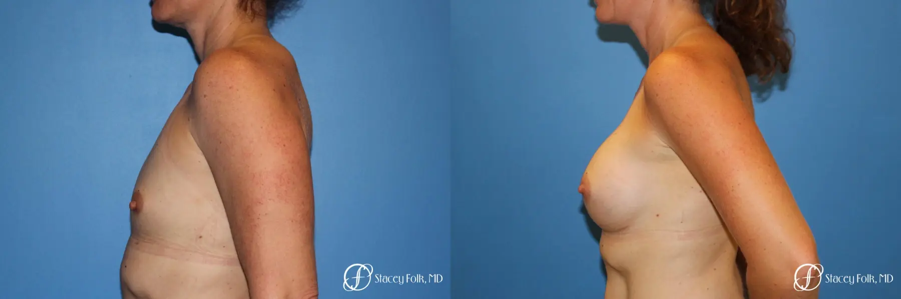 Denver Breast Augmentation 6611 - Before and After 3