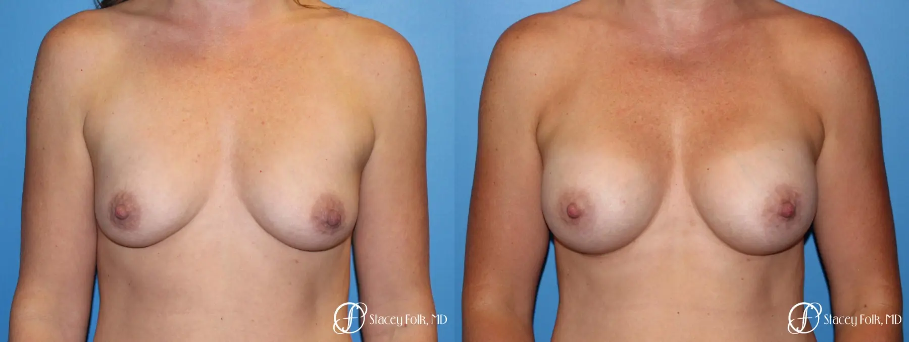 Denver Breast augmentation using Sientra textured anatomic implants 5578 - Before and After
