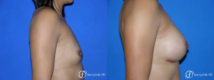 Denver Breast Augmentation 3629 - Before and After 4