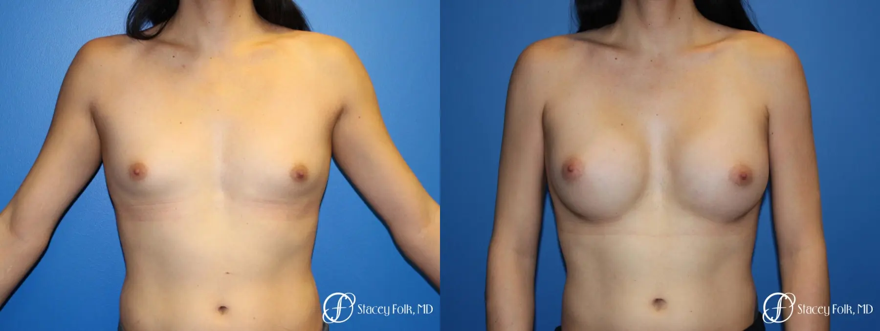 MTF (Male To Female Top Surgery) Breast Augmentation - Before and After