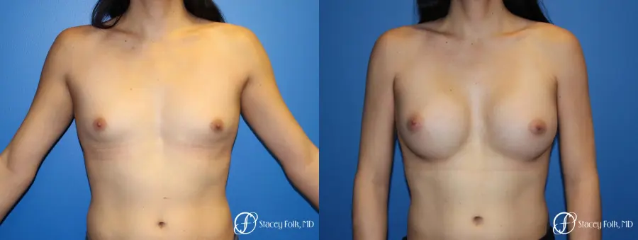 MTF (Male To Female Top Surgery) Breast Augmentation - Before and After 1