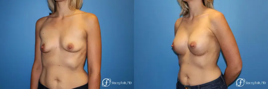 Denver Breast Augmentation 4816 - Before and After 2