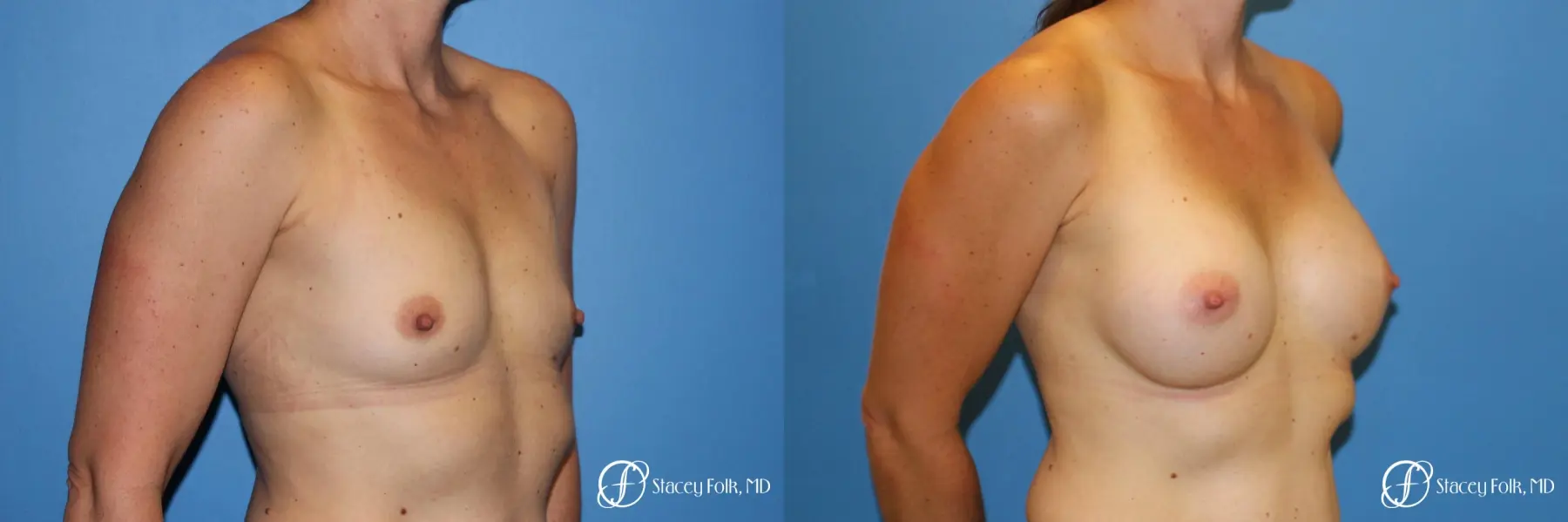 Denver Breast Augmentation 6611 - Before and After 2