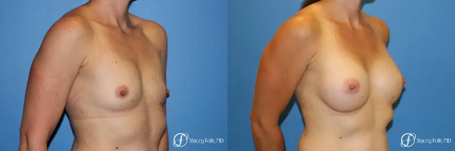 Denver Breast Augmentation 6611 - Before and After 2