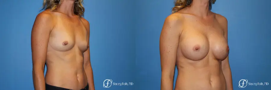 Denver Breast augmentation 4740 - Before and After 2