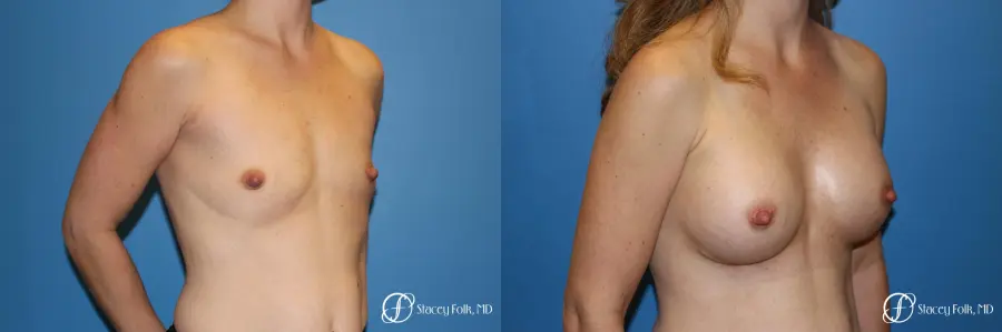 Denver Breast Augmentation using Textured Sientra Breast Implants 8414 - Before and After 3