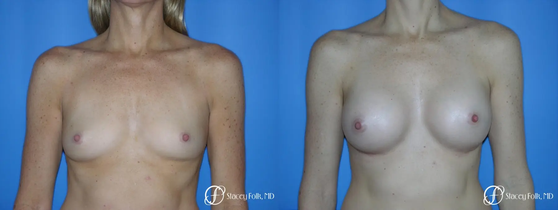 Denver Breast Augmentation 3633 - Before and After 1