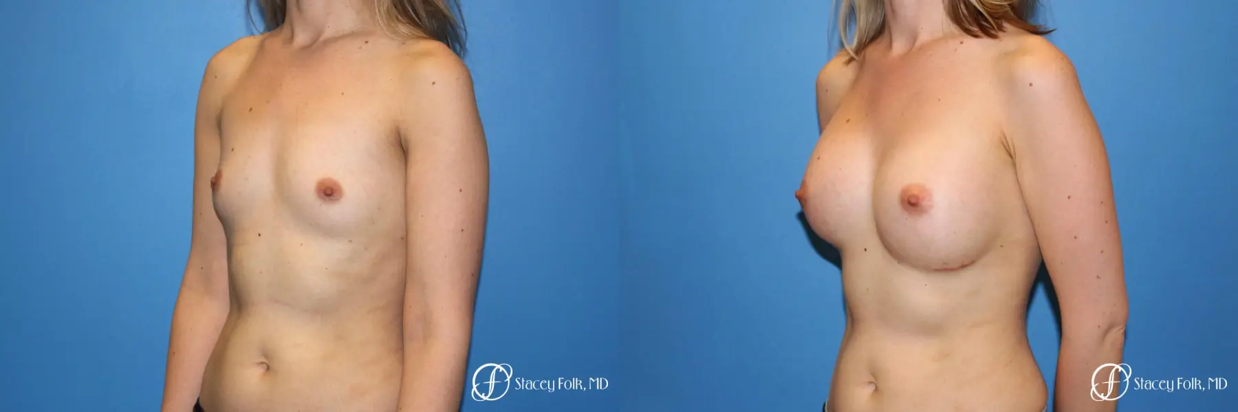 Denver Breast augmentation 7110 - Before and After 2
