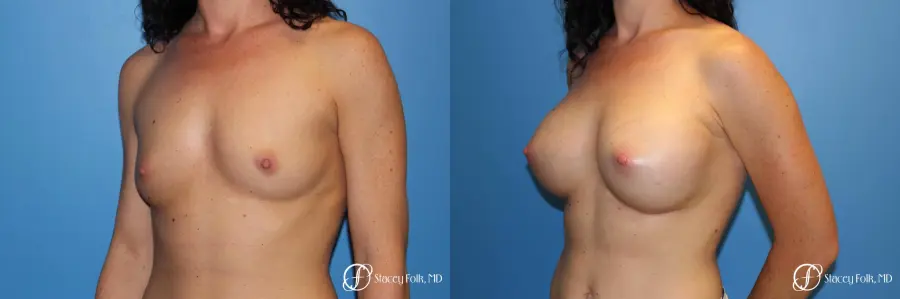 Denver Breast Augmentation using Sientra Breast Implants 7135 - Before and After 2