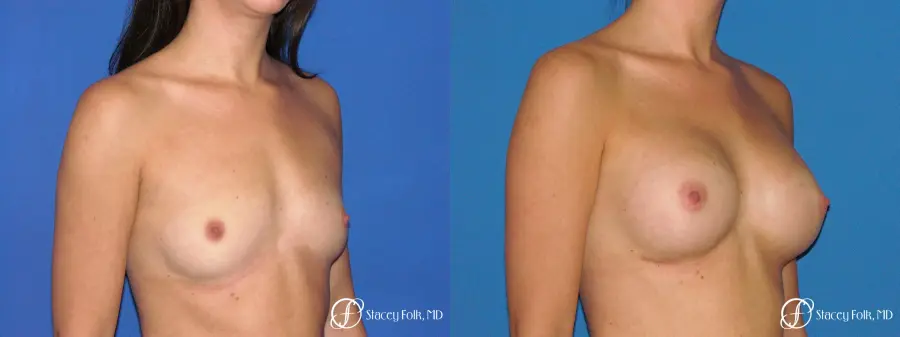 Denver Breast Augmentation 4779 - Before and After 2