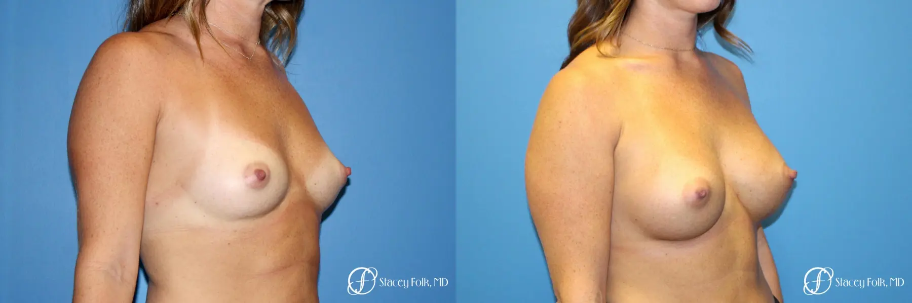 Denver Breast Augmentation using Sientra Silicone Breast Implants 9092 - Before and After 2