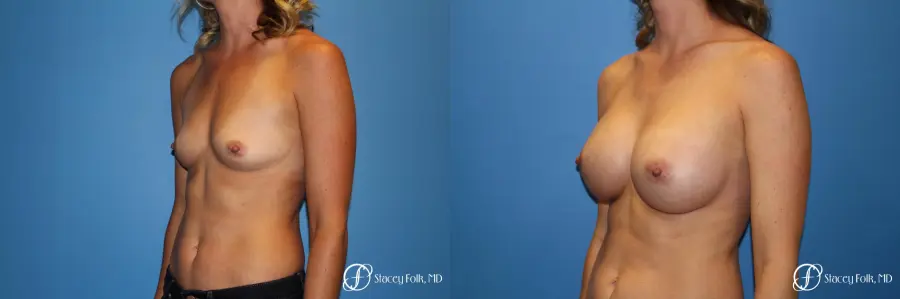 Denver Breast augmentation 4740 - Before and After 3