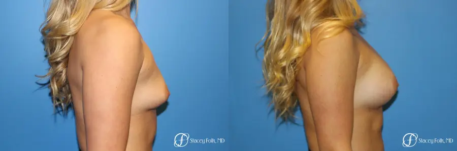 Denver Breast Augmentation with textured Sientra Anatomic Implants 9126 - Before and After 3