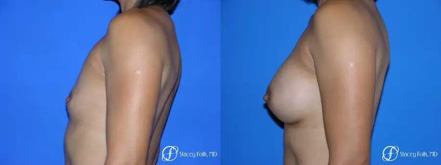 Denver Breast Augmentation 3629 - Before and After 5