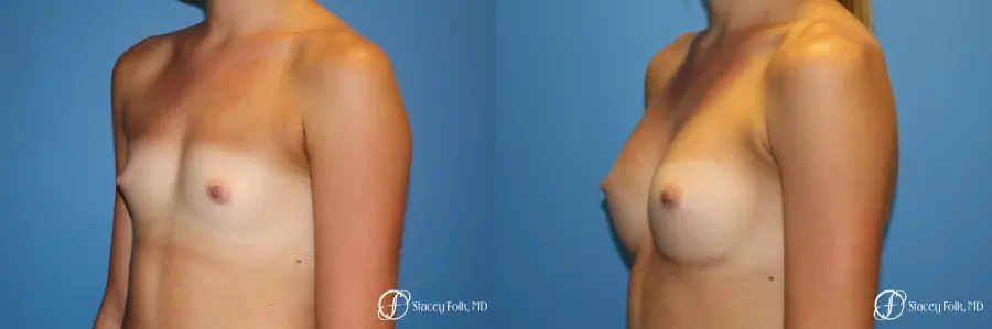 Denver Breast Augmentation with Sientra Breast Implants 9094 - Before and After 2