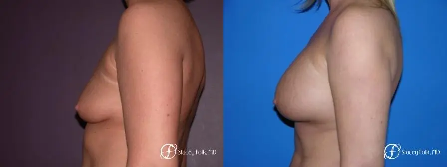 Denver Breast Augmentation 31 - Before and After 3