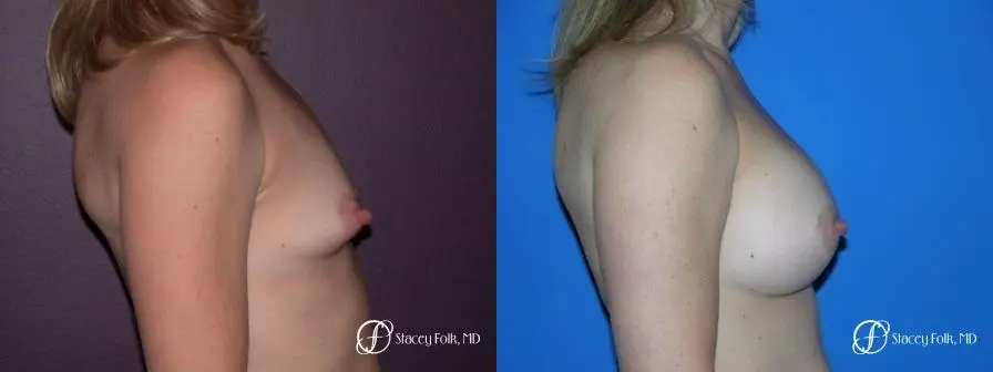Denver Breast Augmentation 959 - Before and After 3