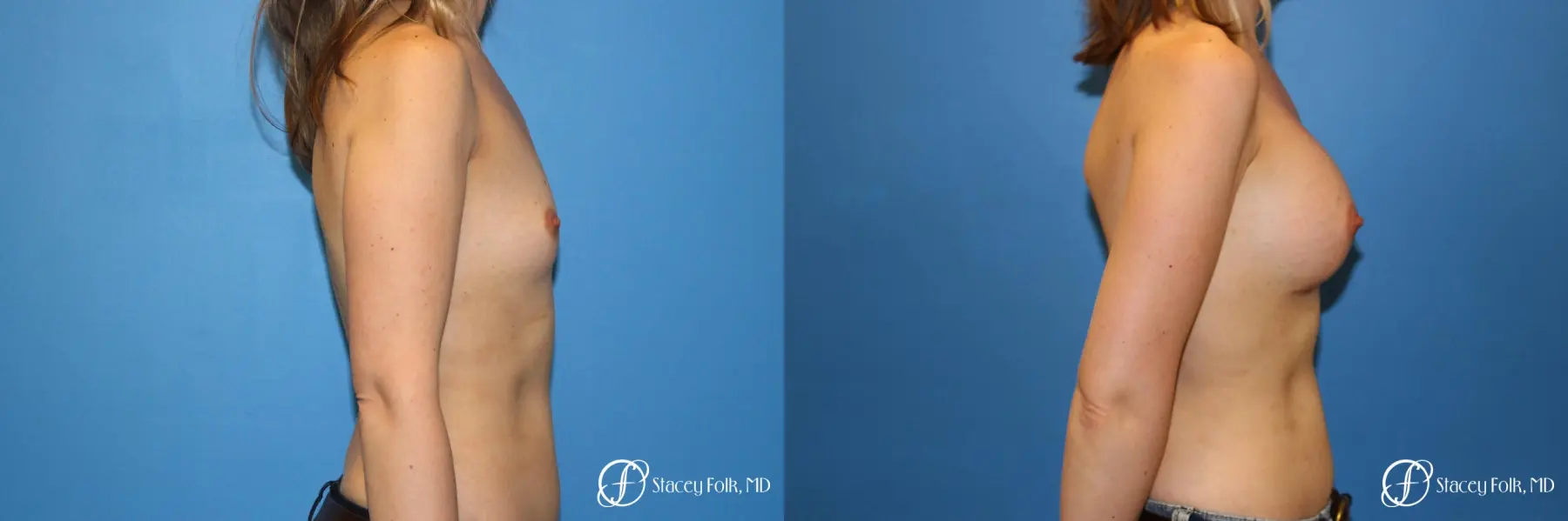 Denver Breast augmentation 7110 - Before and After 3